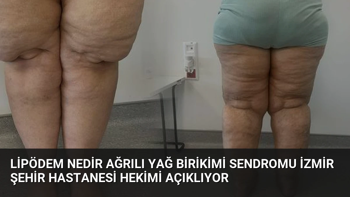 Lipödem Nedir Ağrılı Yağ Birikimi Sendromu İzmir Şehir Hastanesi Hekimi Açıklıyor