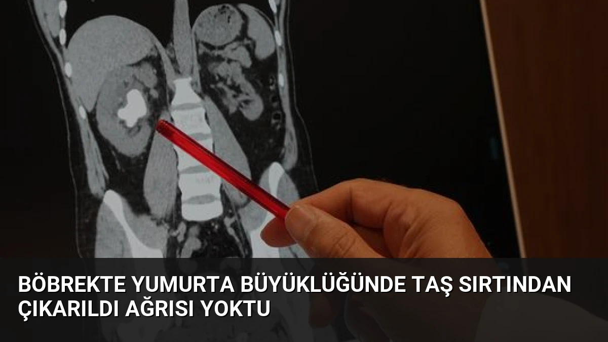 Böbrekte Yumurta Büyüklüğünde Taş Sırtından Çıkarıldı Ağrısı Yoktu