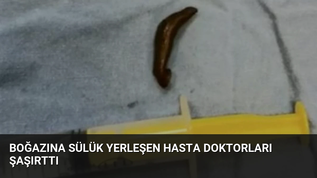 Boğazına Sülük Yerleşen Hasta Doktorları Şaşırttı