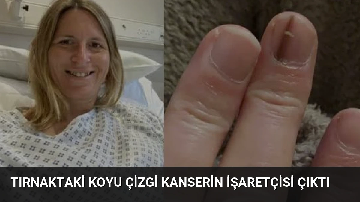 Tırnaktaki Koyu Çizgi Kanserin İşaretçisi Çıktı